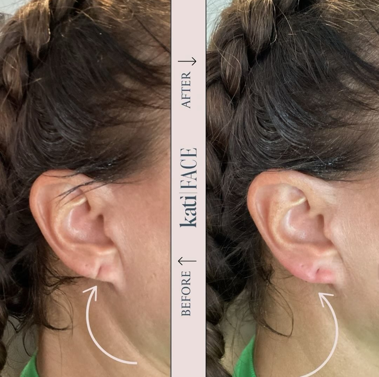Before and after earlobe repair treatment at Kati Face Medical Spa