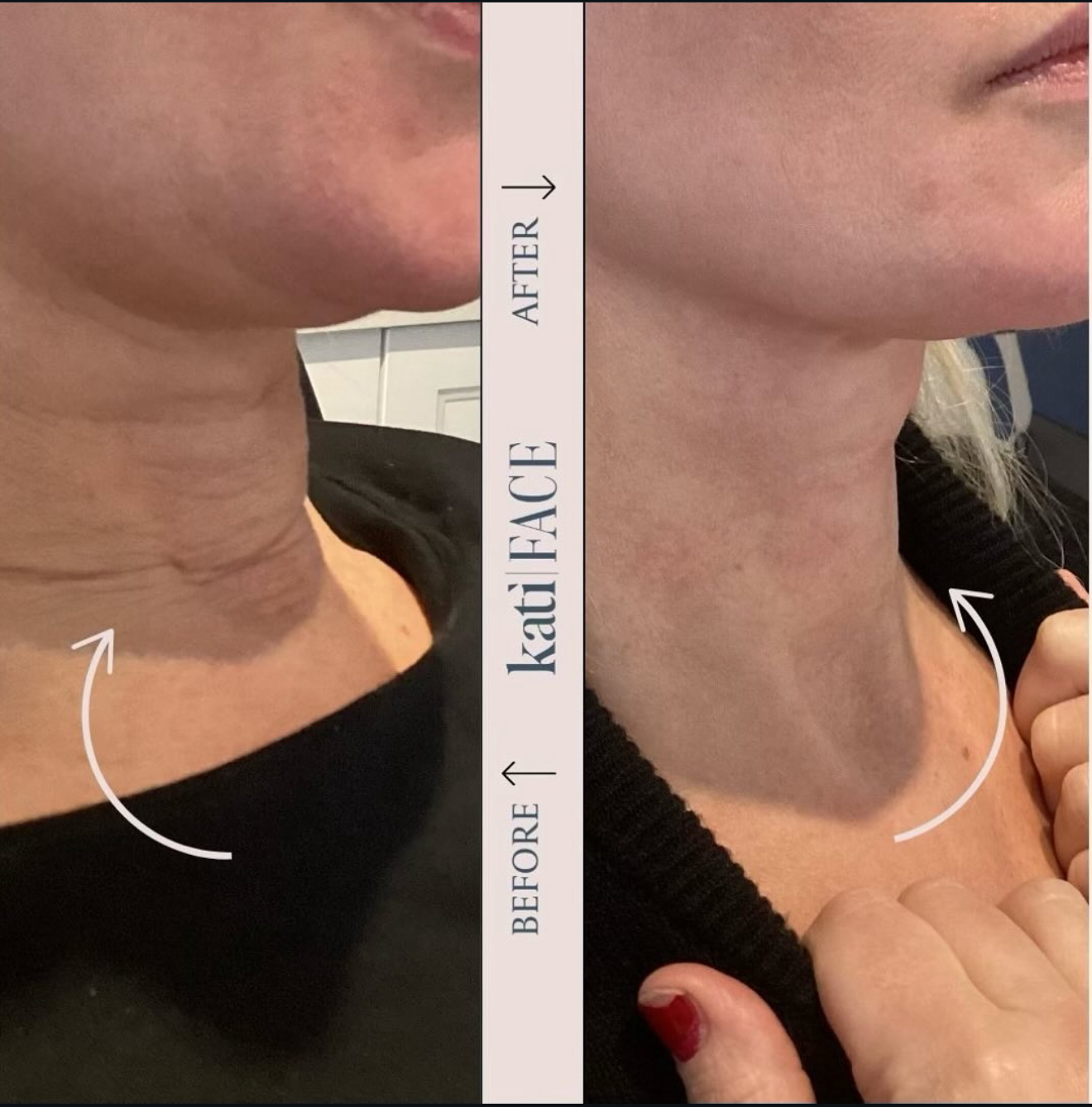 Before and after neck rejuvenation treatment at Kati Face Medical Spa