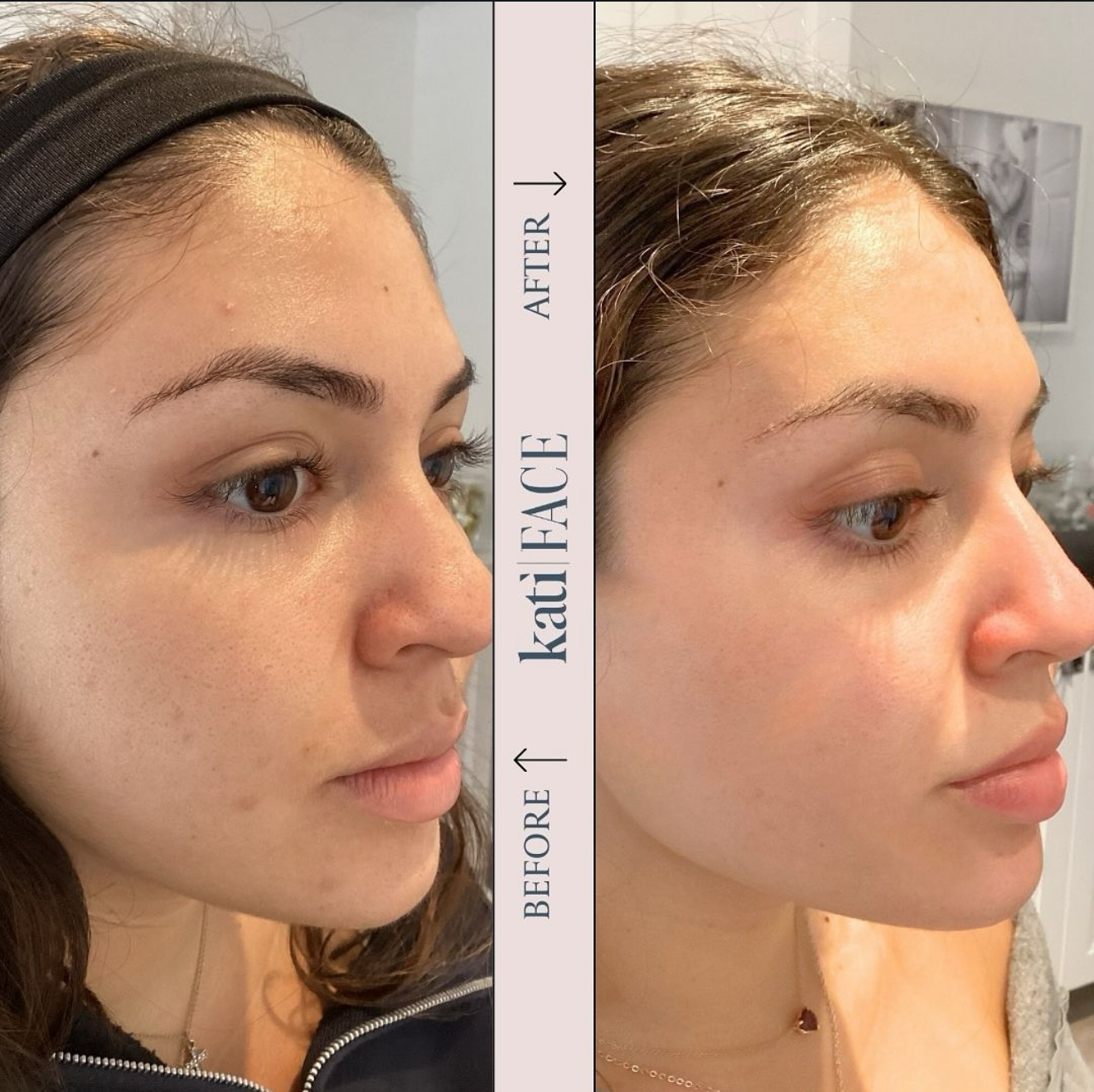 Before and after acne treatment with microdermabrasion and blue light therapy at Kati Face Medical Spa