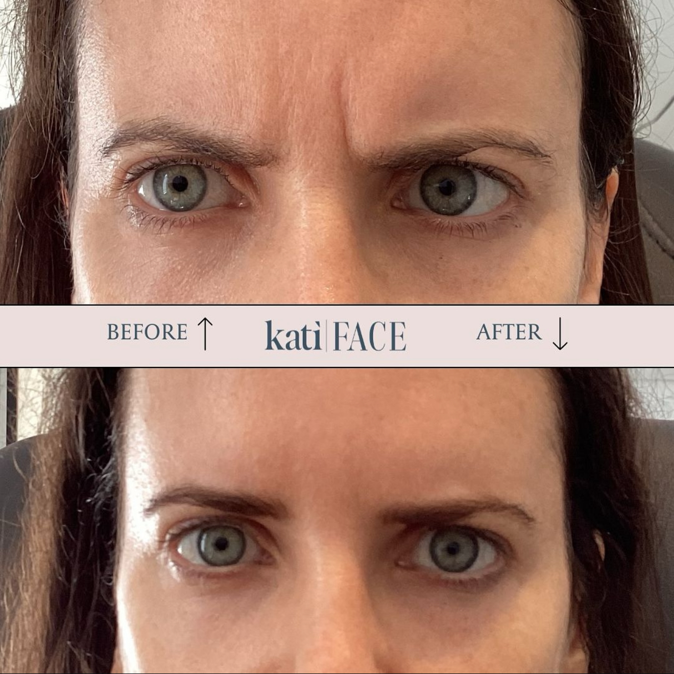 Before and after frown line Botox treatment at Kati Face Medical Spa