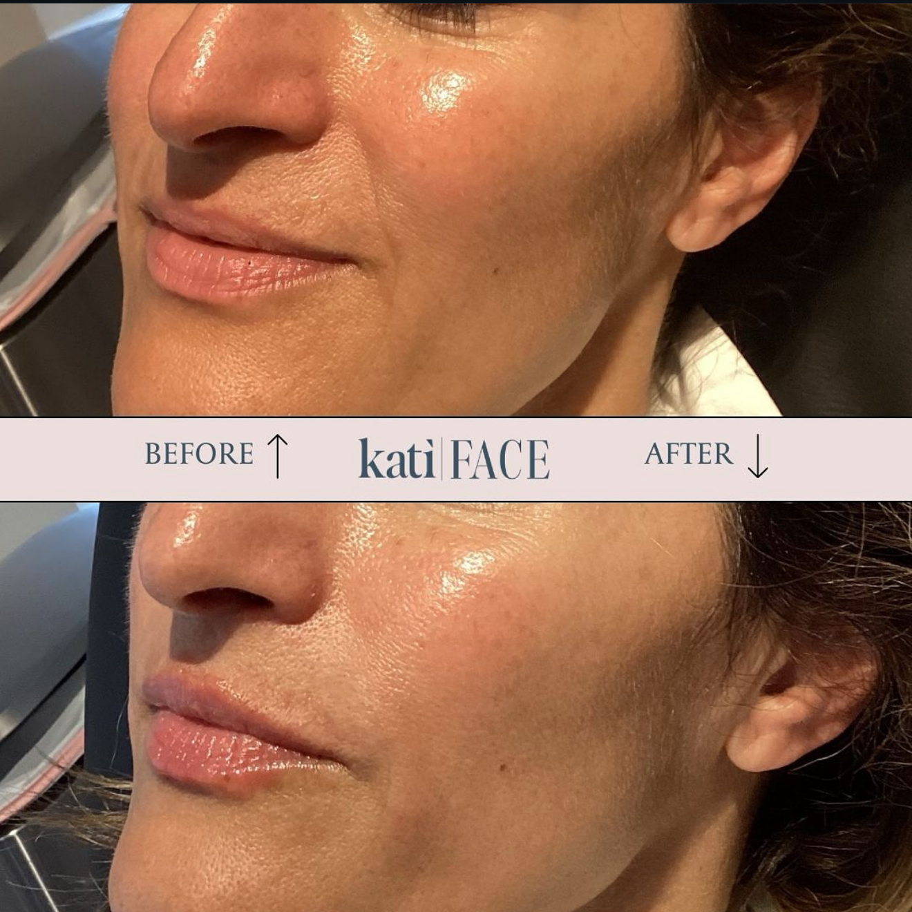 Before and after nasolabial fold and cheek treatment at Kati Face Medical Spa