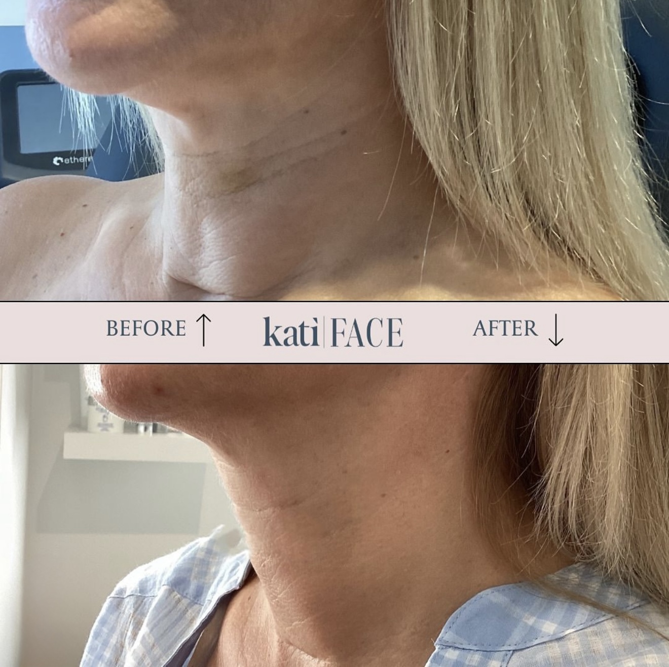 Before and after neck tightening treatment at Kati Face Medical Spa